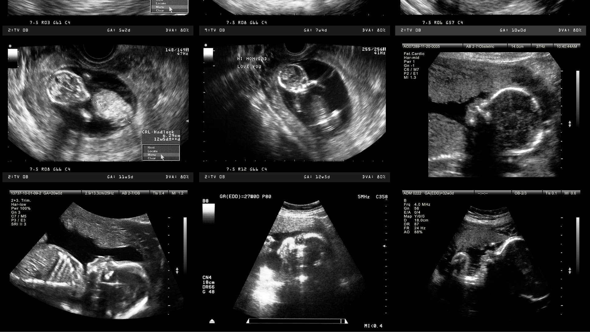 Ensuring Health: Managing Low Potassium in Pregnancy